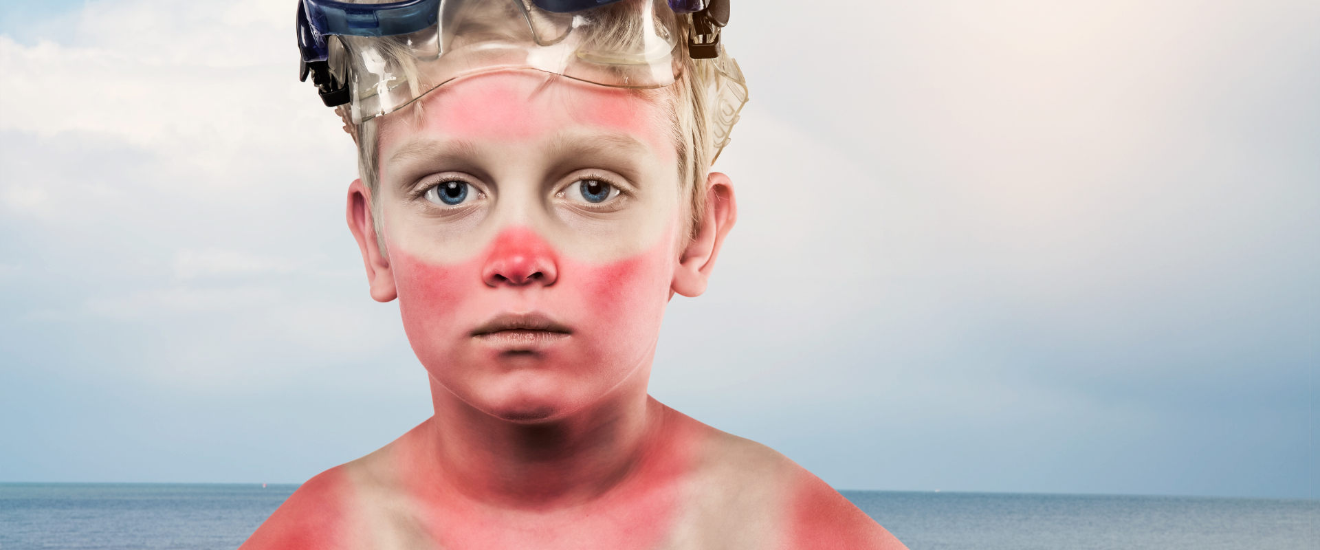 Sunburn in childhood increases the risk of developing skin cancer