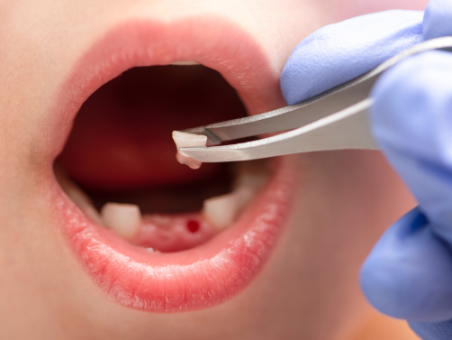 Tooth – A Real-Life Story